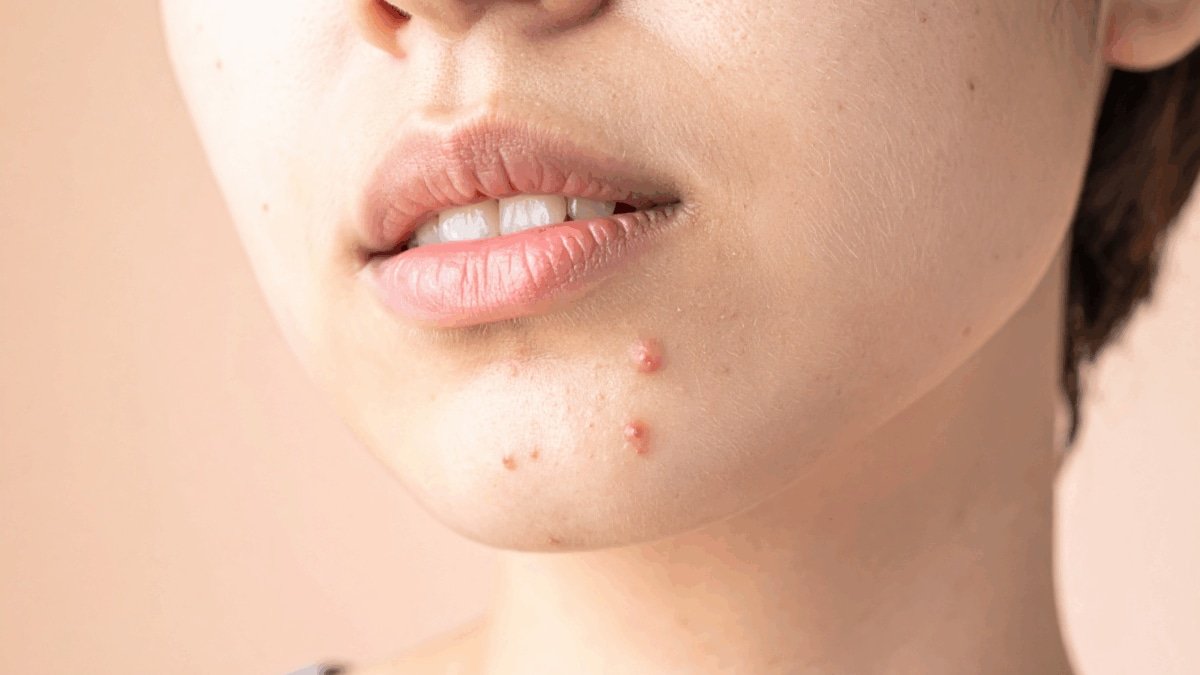 Getting Pimples All Over Your Face This Monsoon? Try These Easy Skincare Tips